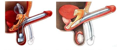 Penile Prothese mat enger opbloosbarer Prothese (lénks) a Plastik (riets)