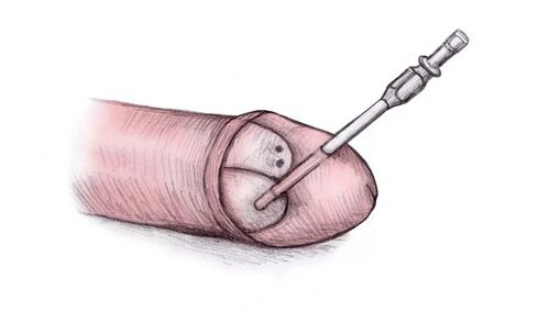 De Kapp vum Penis kann vergréissert ginn andeems en hyaluronesche Gel an d'Injektioun