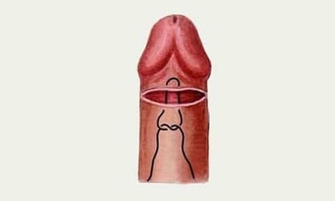 glanz penis